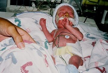 Preterm Babies